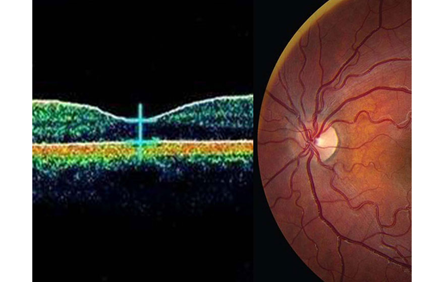 L'application du galvanomètre à balayage Hansel dans l'imagerie ophtalmique